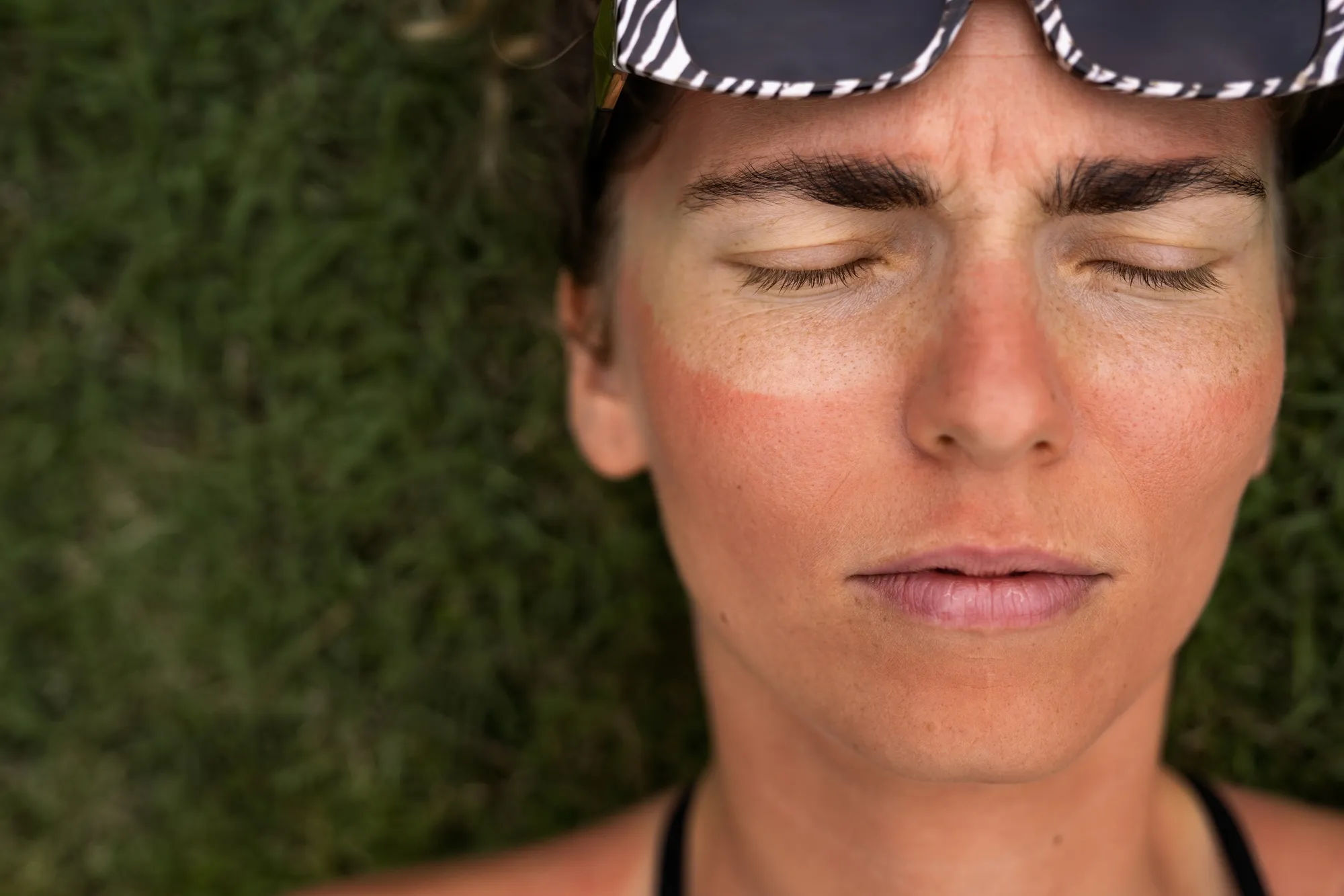 Portrait of adult woman with sunburn skin
